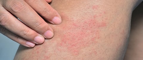 تجمع القصيم الصحي يحذر من انتشار الطفح الجلدي الحراري خلال الصيف