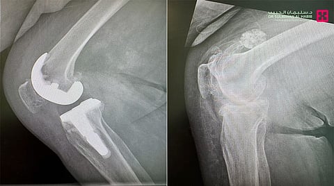 مستشفى‎ الدكتور سليمان الحبيب بالخبر يعيد الحركة لثمانينية بعملية استبدال مفصل ركبة جرت بتقنية الجراحة بالروبوت