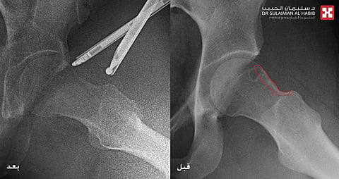 مجمع الدكتور سليمان الحبيب بالعليا يستأصل ورماً نادراً بمفصل الورك لثلاثينية بالمنظار
