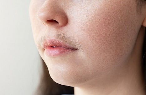 طبيبة روسية تكشف: متى يصبح شعر الوجه عند النساء مؤشرًا صحيًا خطيرًا؟