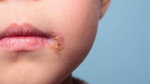 تقنية مبتكرة مناعية تحيّد فيروس الهربس وتفتح آفاقًا جديدة للوقاية