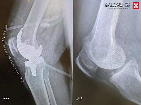 مستشفى الدكتور سليمان الحبيب بالمحمدية في جدة يُعيد قدرة المشي لستينية بإجراء جراحة دقيقة لاستبدال مفصلي الركبة