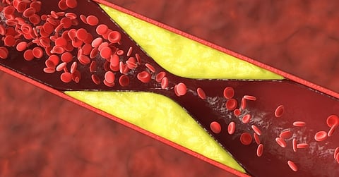 على عكس الرجال.. دراسة: نصف حالات النوبات القلبية لدى النساء الأصغر سنًا لا تنتج عن تجلط الدم الشرياني