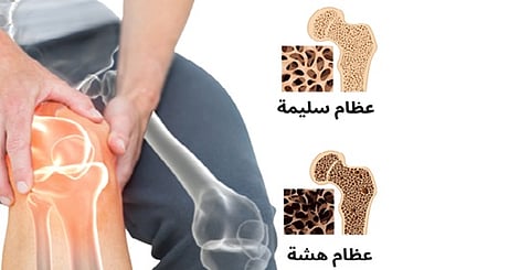 في اليوم العالمي لهشاشة العظام.. 7 خرافات شائعة يفنّدها الطب