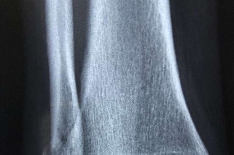 "ليس الألم فقط".. دراسة: أدوية شائعة لعلاج الألم تمنع نمو سرطان العظام