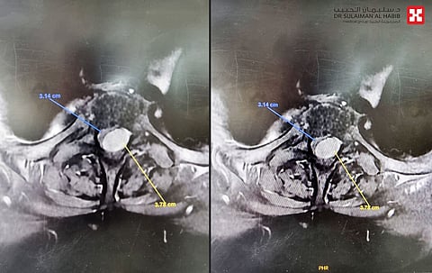 مجمع الدكتور سليمان الحبيب الطبي بالعليا يعيد الحركة لـ"ستينية" بجراحة مجهرية دقيقة