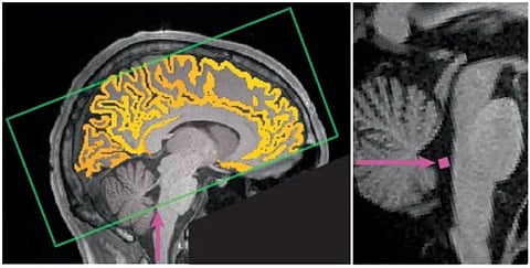 البروفيسور "باهمام" يستعرض دراسة حديثة: الحرمان من النوم يهدد صحة الدماغ والجسم