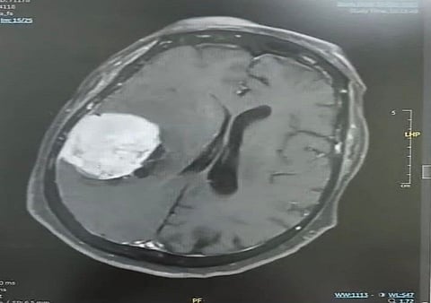 كانت تعاني من صداع مزمن.. نجاح عملية نوعية لاستئصال ورم دماغي لسيدة ثمانينية في مستشفى ينبع العام