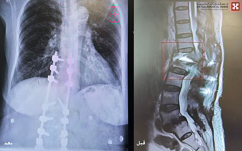 مستشفى الدكتور سليمان الحبيب بالخبر يُعيد قدرة المشي لسبعينية أصيبت بتشوه بالعمود الفقري نتيجة "5" عمليات سابقة غير ناجحة 