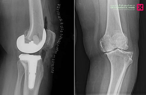 مستشفى الدكتور سليمان الحبيب بالقصيم ينهي معاناة "ستينية" بعملية استبدال مفصل ركبة نوعية