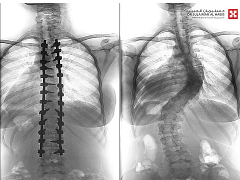 مستشفى الدكتور سليمان الحبيب بالفيحاء في جدة يجرى عملية ناجحة لتقويم "جنف" مزدوج بزاوية "63" و"45" درجة