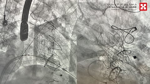 مستشفى الدكتور سليمان الحبيب بالتخصصي يزرع "صمامًا خارجيًا" وينقذ حياة مراجعة بحالة معقدة