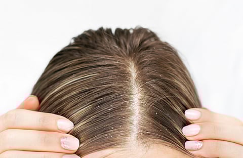 المياه العسرة قد تكون سببًا خفيًا لقشرة الرأس المزعجة