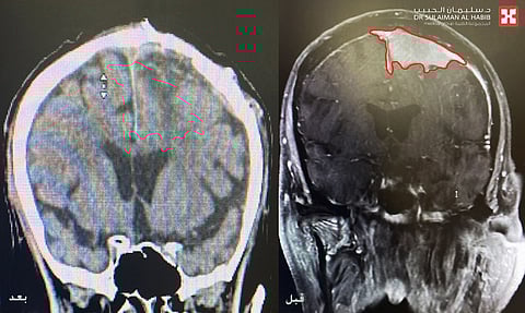 مجمع الدكتور سليمان الحبيب بالعليا يستأصل ورماً دماغياً كبيراً سبب صداع مزمن وتشنجات حادة لمراجع سبعيني 
