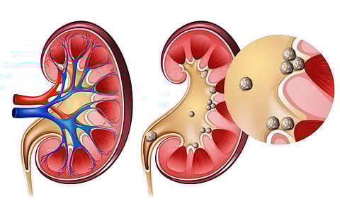 ليس قلة الماء فقط.. 6 أسباب شائعة لتكون حصوات الكلى