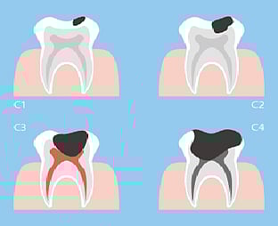 ليست الحلويات فقط.. طبيب بريطاني: أطعمة ومشروبات غير متوقعة تسبب تسوس الأسنان