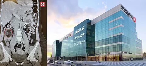 مستشفى الدكتور سليمان الحبيب بالحمراء يسـتأصل ورماً في القولون بطول 6 سم سبب الكثير من المضاعفات الحادة لثلاثينية