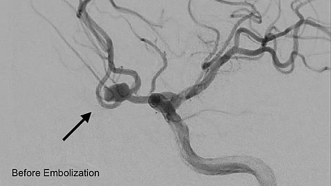 مستشفى المانع بالأحساء ينجح في تنفيذ أول إجراء لإغلاق تمدد شرياني دماغي بالقسطرة