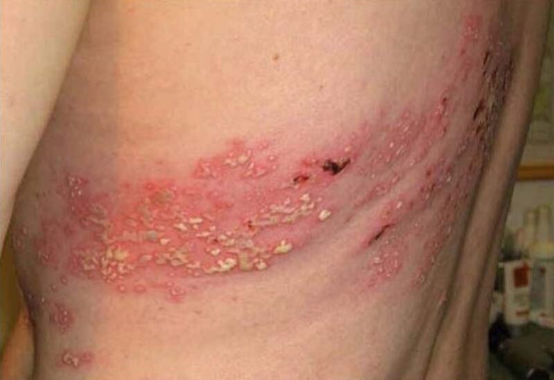 الخضيري يحذّر: مناعة الحزام الناري قد لا تستمر أكثر من عامين. المناعة بعد الإصابة غالبًا مؤقتة. قد لا تتجاوز سنة إلى سنتين. ضعف المناعة قد يسبب تكرار الإصابة. اللقاح بعد عام من الشفاء خيار مناسب. اللقاح يوفّر حماية تمتد لنحو 10 سنوات 