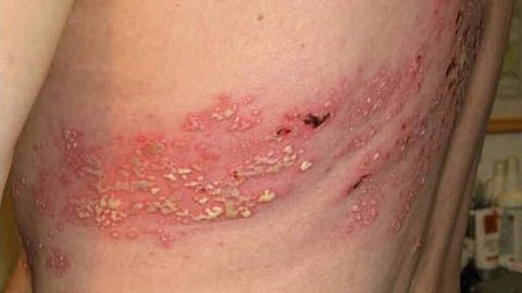 الخضيري يحذّر: مناعة الحزام الناري قد لا تستمر أكثر من عامين