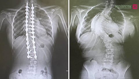 مستشفى الدكتور سليمان الحبيب بالقصيم يجرى عملية ناجحة لتقويم "جنف" بزاوية "95" درجة