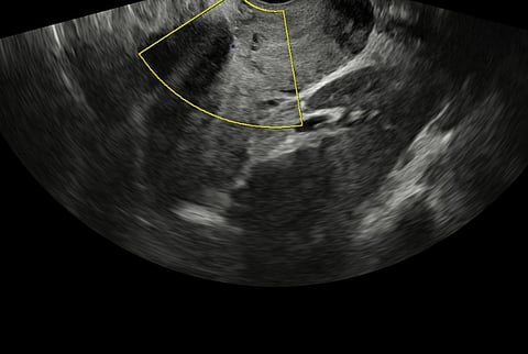 مستشفى المانع العام بالدمام ينجح في إنقاذ أم وجنينها في حالة توليد عالية الخطورة