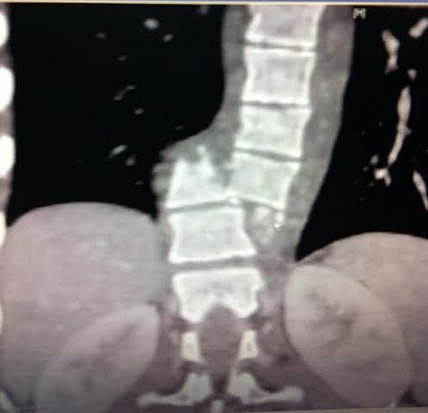 فريق طبي سعودي بعسير يجري عملية جراحية دقيقة بالعمود الفقري