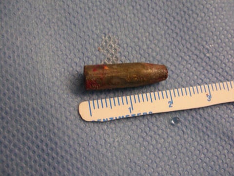 نجران .. فريق طبي يُنقذ مريضاً استقرت رصاصة عابرة في عينه