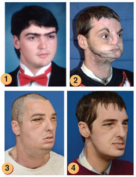 "ريتشارد نوريس" يجري عملية زراعة الوجه للمرة 31