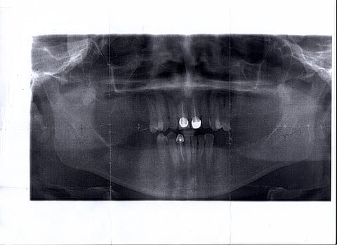 97 ألف ريال كافية لزراعة أسنان لشاب يعاني العوز و"الإحراج"
