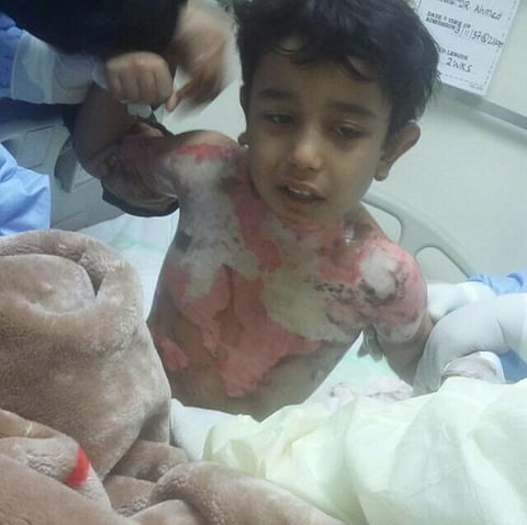 مستشفيات بالرياض وأبها ترفض "طفل الحروق".. ووالده: مهدد بالتشوه!