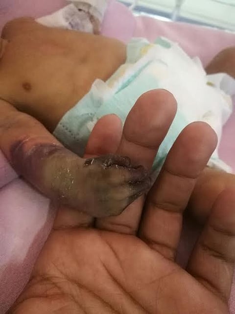 "الصحة" تتوعد المقصرين في قضية طفل جازان المهدد ببتر يده.. والأب: أنقذوه أولاً