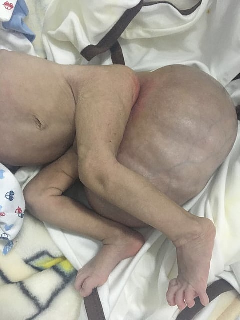 استئصال ورم عصعصي لطفل في جراحة نادرة بـ "سعود الطبية"