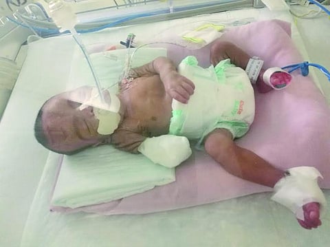 "صحة جازان" تعترف: الإهمال بتر كف "منصور".. ووالده: الصيغة تقلقني