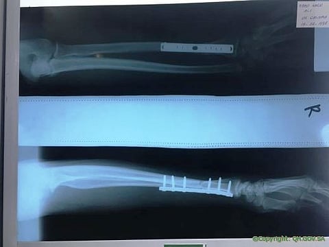 القصيم.. جراحة ناجحة لتقصير عظمة ساعد تنهي معاناة مريض