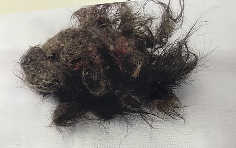 جراح يستخرج كيساً دهنياً طوله 16 سم من على مبيض فتاة ويؤكد: ليست مسحورة