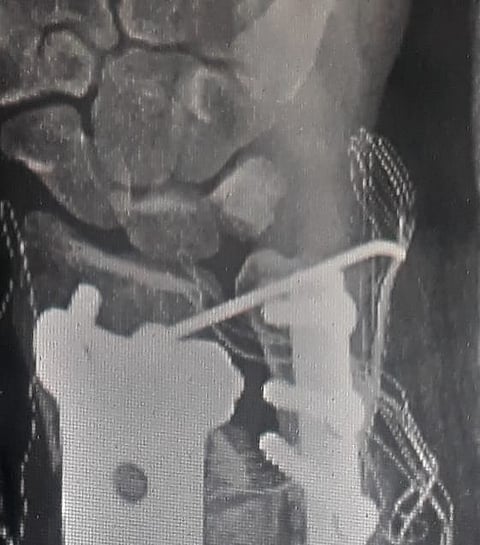 شاهد.. حادث سير يفتت عظام وافد وعملية معقدة ترمّمها بمستشفى بدر