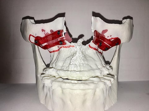 "فهد الطبية" تبتكر تقنية لـ"قص عظام الوجه والفكين" بدقة