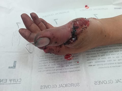 جراحة دقيقة تنقذ يد مريض من القطع بمكة.. أصيب بمنشار كهربائي
