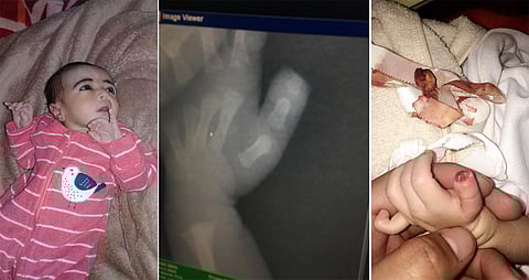 مستشفى يبتر إصبع مولودة حديثًا.. وممرضة تدَّعي: كانت ترضع إصبعها ما أدى لقطعها