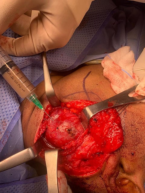 تدخل جراحي ينقذ حدثًا من ورم حميد في الرقبة في مكة المكرمة