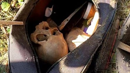 The skeleton case is finally solved: The human skull found in Bangaon was a medical student's practical material.