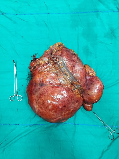मरीज के पेट से निकला रेट्रोपेरिटोनियल ट्यूमर