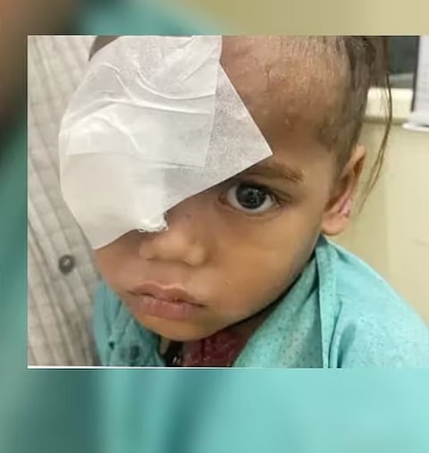3 साल के बच्चे की आंख में घुसा कीड़ा, ऑपरेशन हुआ तो जिंदा निकला