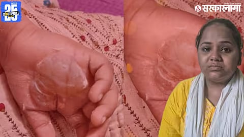 8-year-old student burned by teacher