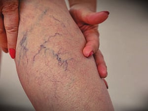 varicose veins