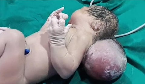 Silchar Newborn With Rare Skull Deformity