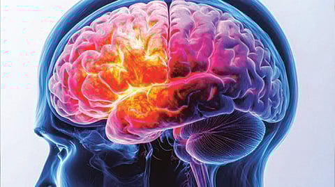 Alzheimer’s disease