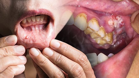 Alcohol, smokeless tobacco driving 62% mouth cancer cases in India'