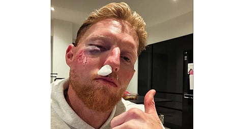 England Test captain Ben Stokes suffers facial injury after being hit by ball